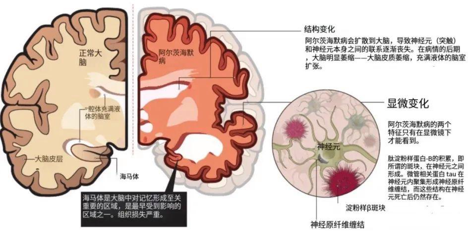 用脑太少和用脑过度，哪个更易“老年痴呆”？相关图片
